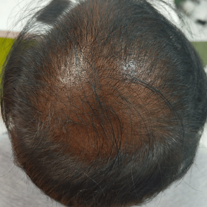 Hair Loss Before